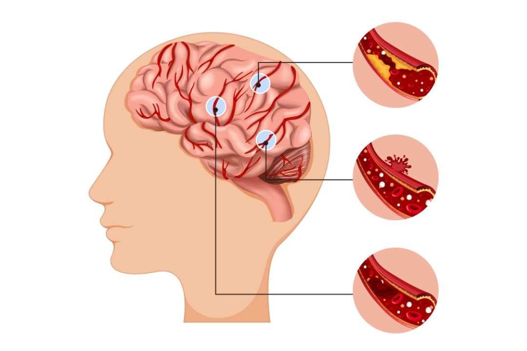Studi Menunjukkan Pasien Stroke di Indonesia Kehilangan Waktu Berharga